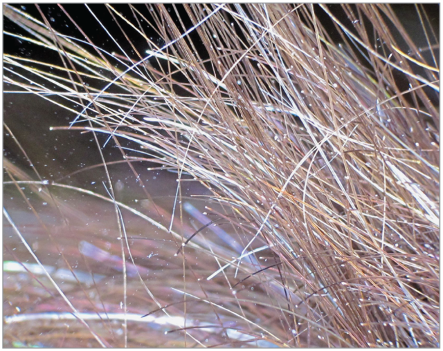 Trichorrhexie Noueuse (Trichorrhexis Nodosa)